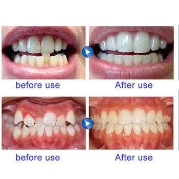 Uređaj Za ortodontske Bravice Zubni Aparatić Bruksizam Štitnika Straightener Zubi